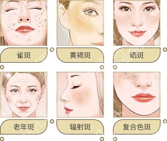 激光去除老年斑怎么样？会留疤吗？需要调节几次？