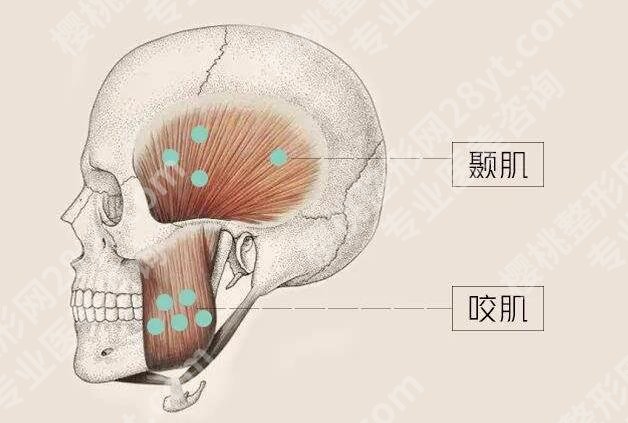 咬肌发达怎么办？怎么瘦下来？注射瘦脸挺有用！