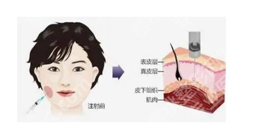 咬肌发达怎么办？怎么瘦下来？注射瘦脸挺有用！