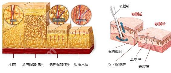 北京八大处吸脂贵吗？哪个医生好？价格费用表明细\郭鑫简介\案例图