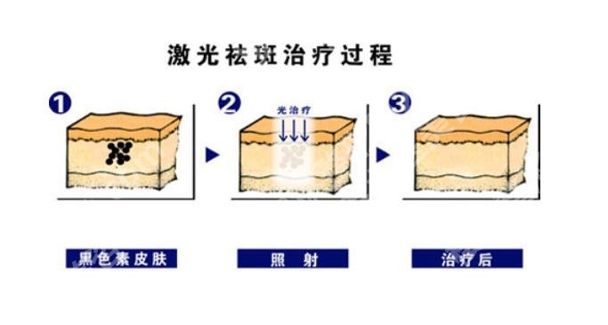 北京圣嘉新医疗美容医院祛斑价格:2000元左右起！内附真人祛斑案例图