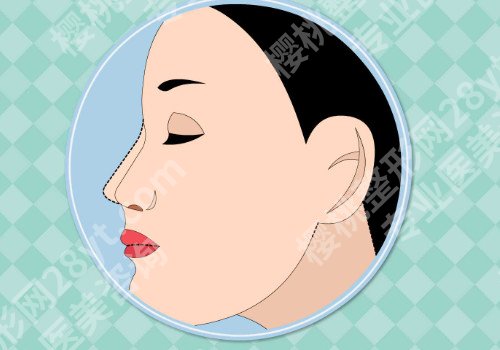 南昌假体隆鼻要多少钱？术后消肿怎么样？