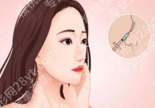 绍兴肋骨鼻子大概多少钱？有没有排异现象？