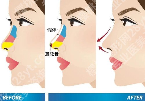 武汉肋骨鼻子大概多少钱?术后多久消肿？