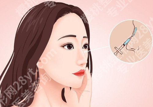 银川假体隆鼻要多少钱?真实案例分享!