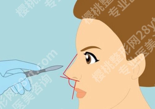 合肥肋骨鼻子大概多少钱？怎么降低风险发生的几率
