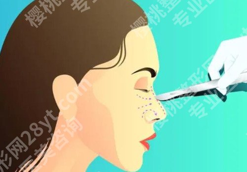 西安肋骨鼻子大概多少钱？案例分享术前术后情况！