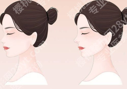 石家庄假体隆鼻要多少钱？进来看多久恢复自然？