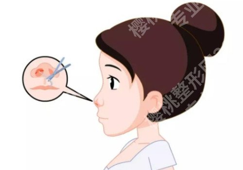 无锡假体隆鼻要多少钱？恢复后鼻子又高又翘！