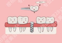 南京种植牙案例，牙齿真正得到了修复！
