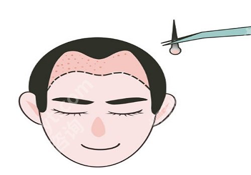 植发有用吗,可以维持多久？