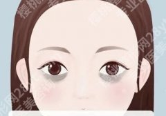 去黑眼圈有效的方法？黑眼圈分为什么呢？