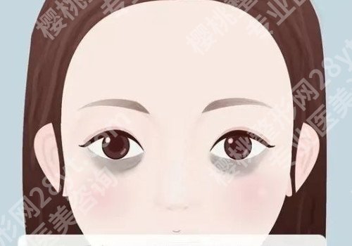 去黑眼圈有效的方法？黑眼圈分为什么呢？