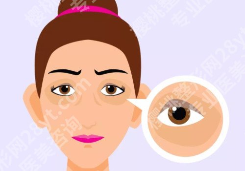 去黑眼圈有效的方法？黑眼圈分为什么呢？