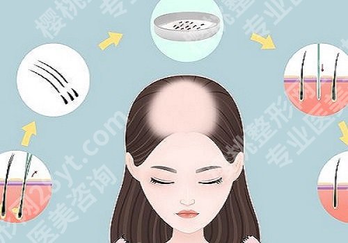 植发有用吗,可以维持多久?