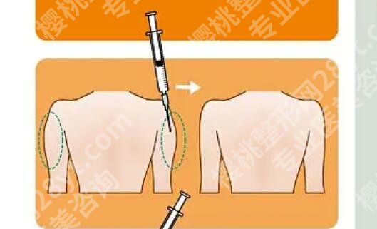 水动力吸脂手术效果怎么样？5家医院背量介绍！价格预览!