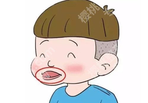 矫正地包天的费用要多少？案例过程详细解析！注意事项分享！