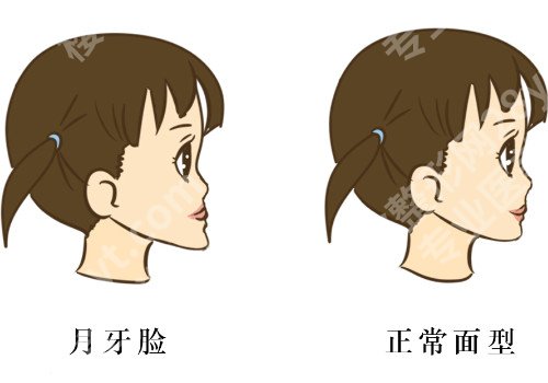 矫正地包天的费用要多少？案例过程详细解析！注意事项分享！