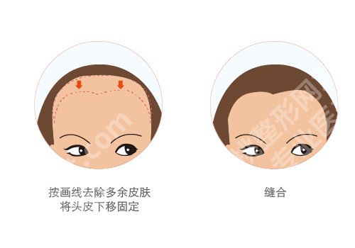 额头缩小术前后对比照，带你了解有价值的科普知识信息！