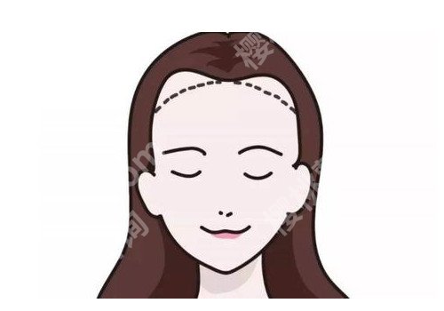 额头缩小术前后对比照，带你了解有价值的科普知识信息！