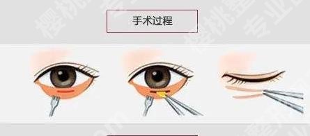 济南第二人民医院去眼袋多少钱？价格3800元到8000元不等！附案例