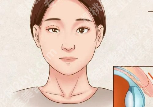 成都割双眼皮的价钱，多家医院基本信息介绍！附价格表！