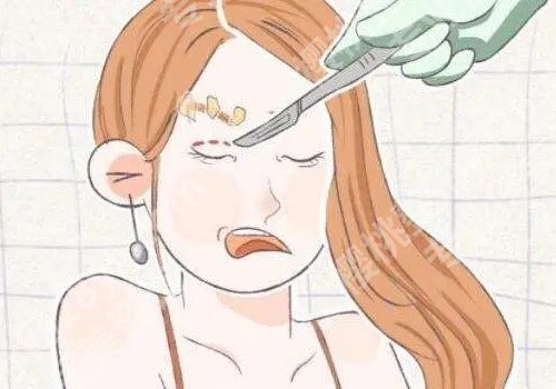 北京割双眼皮大概多少钱?术后恢复需要多久?注意事项有哪些?