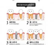 北京牙管家口腔诊所种牙多少钱？单颗牙种植价格大概4000元起！