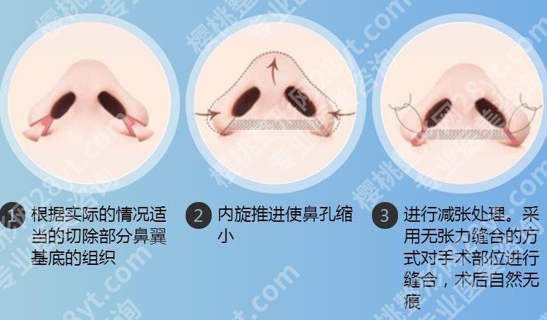 李劲良做鼻子什么风格？口碑好吗？医生资料、价格详情公布！