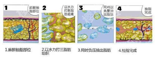 靳玉彪在哪家医院？个人简介、吸脂案例在线一览！术前必看