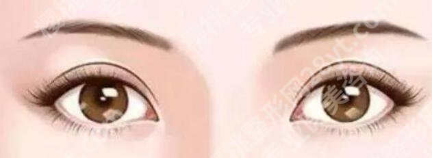 清远人民医院美容整形科怎么样？医院口碑|双眼皮案例反馈！