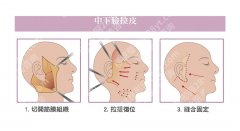 九院丁伟拉皮手术案例曝光，内附医生信息、口碑资料！