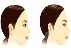 鼻头鼻翼缩小对比照，一篇案例分享可详情看术前、术后变化