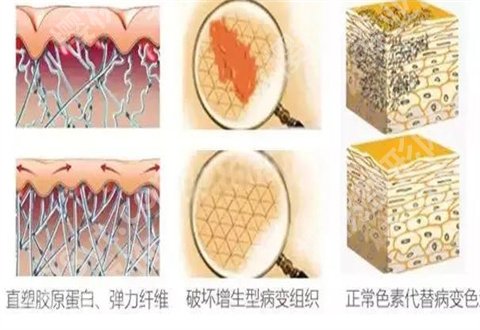激光去疤痕修复效果图公布，真人反馈术前术后介绍了