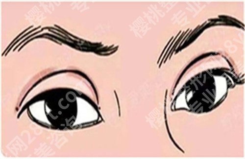 常冬青双眼皮修复算是专家吗？双眼皮修复案例分享