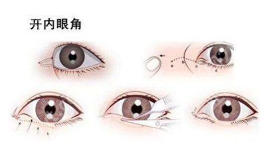 北京画美医疗美容医院开眼角好吗？真人效果图展示！