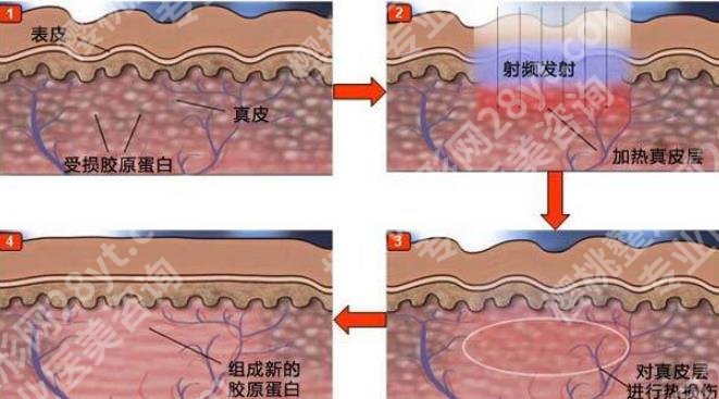 北京和颜一美医疗美容医生团队技术如何?射频除皱案例