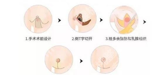 武汉大学人民医院缩胸多少钱？医生专家谁好？价格2w元起！