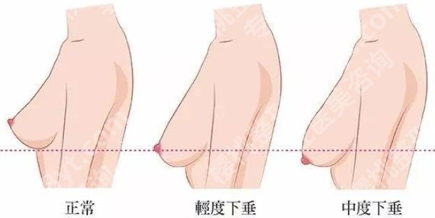 乳房提升棒棒糖手术案例图曝光！手术费用贵吗？