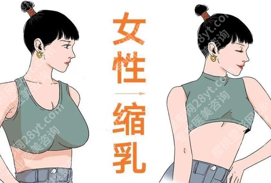 乳房缩小棒棒糖手术法好不好？优点有哪些？戳进来了解一下吧