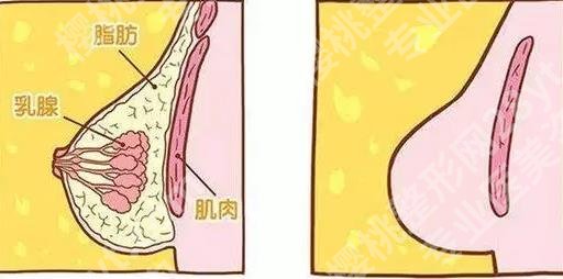 乳房缩小提升术有哪些风险?做完胸部手术后多久恢复