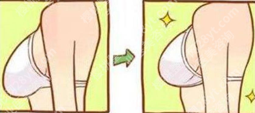 乳房提升棒棒糖切口跟双环切口区别是什么?那种性价比较高!