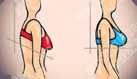 乳房提升棒棒糖切口跟双环切口区别是什么?那种性价比较高!
