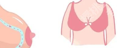 乳房提升棒棒糖切口跟双环切口区别是什么?那种性价比较高!