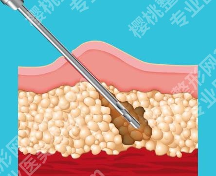 酷塑溶脂一次可以瘦多少？原理是什么？一般可以做几次