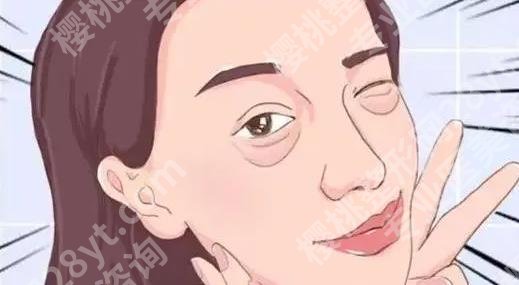 邵逸夫医院去眼袋好吗？技术优势介绍！眼袋案例