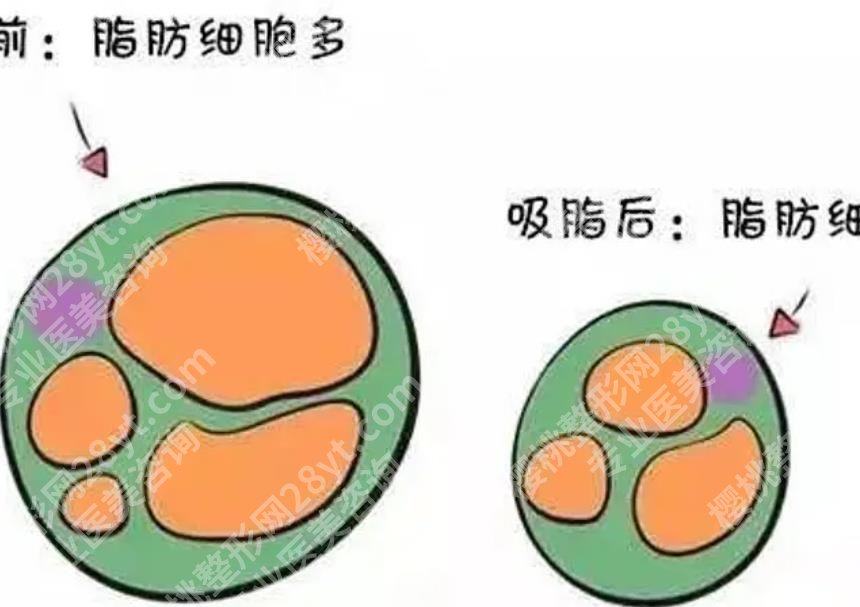 合肥第一人民医院抽脂价格贵不贵？张娅医生抽脂案例