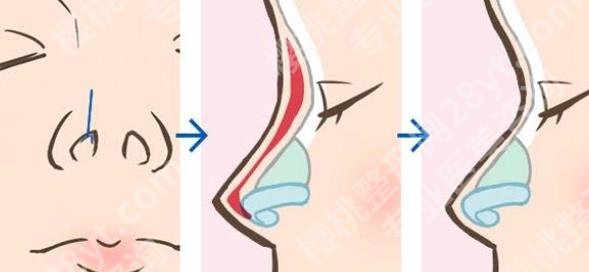 芜湖弋矶山医院做鼻子好吗？朱唯力vs潘勇谁的技术好？实例图