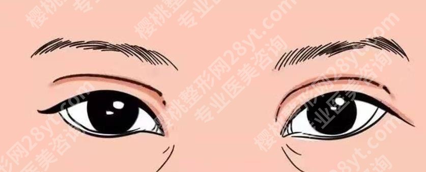 九院丁伟修复双眼皮怎么样？丁医生实操双眼皮修复案例曝光！