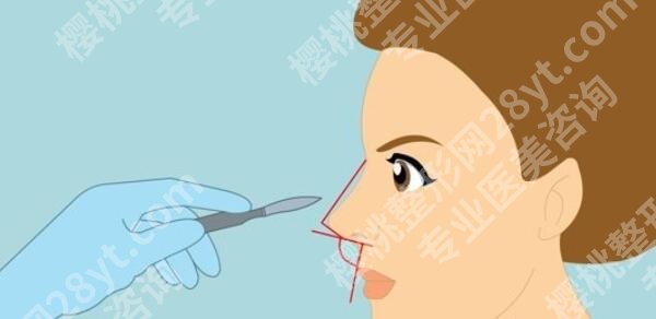 北京蒂凡妮医疗美容医院王志坚医生怎么样？医生简介|真人隆鼻案例分享！